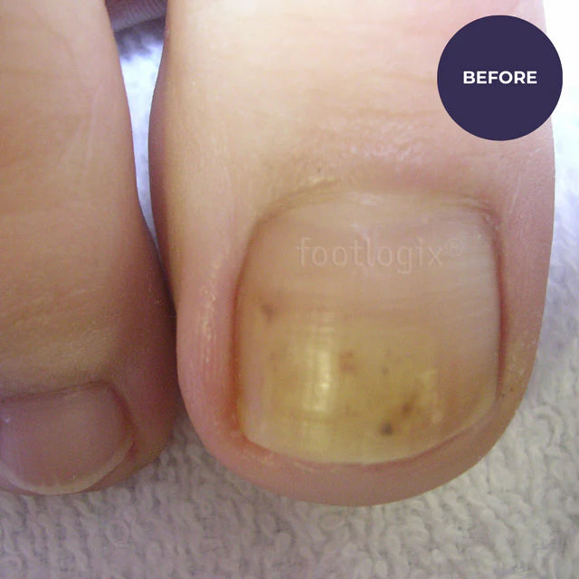 Footlogix Toe Nail Tincture (50ml)
